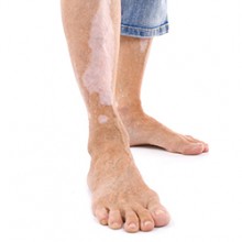 La psoriasis el precio en moskve