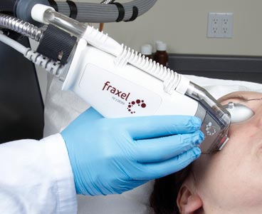 Tecnología Láser Fraxel Relyant